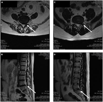 A diagnostic model of nerve root compression localization in lower lumbar disc herniation based on random forest algorithm and surface electromyography